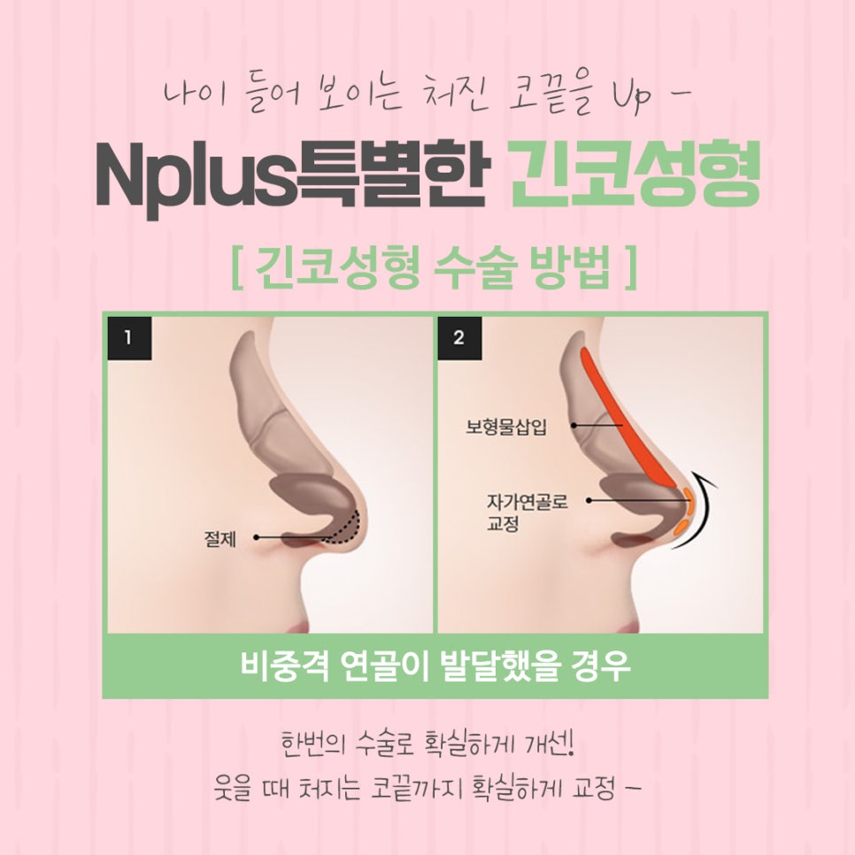 긴코성형으로 교정하고 동안 되자 관련 이미지 8