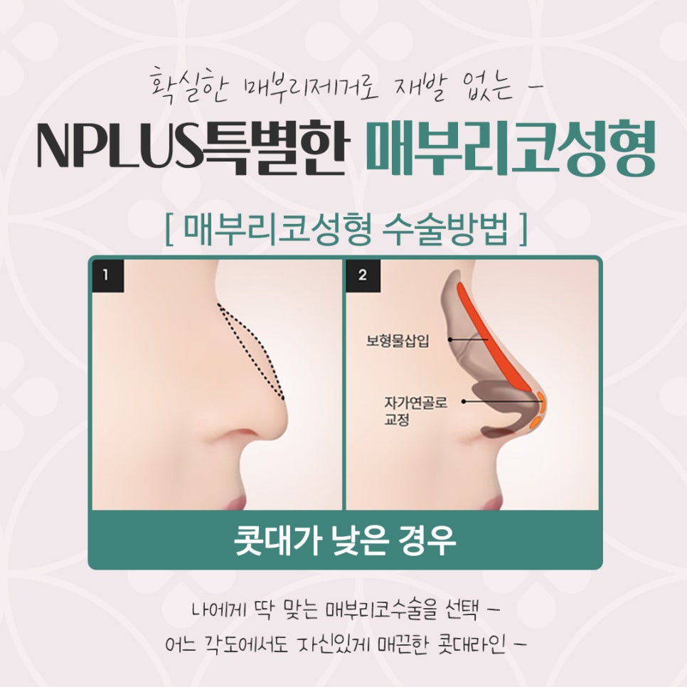 매부리코성형후기 다양한 내용을 찾아보고 관련 이미지 9