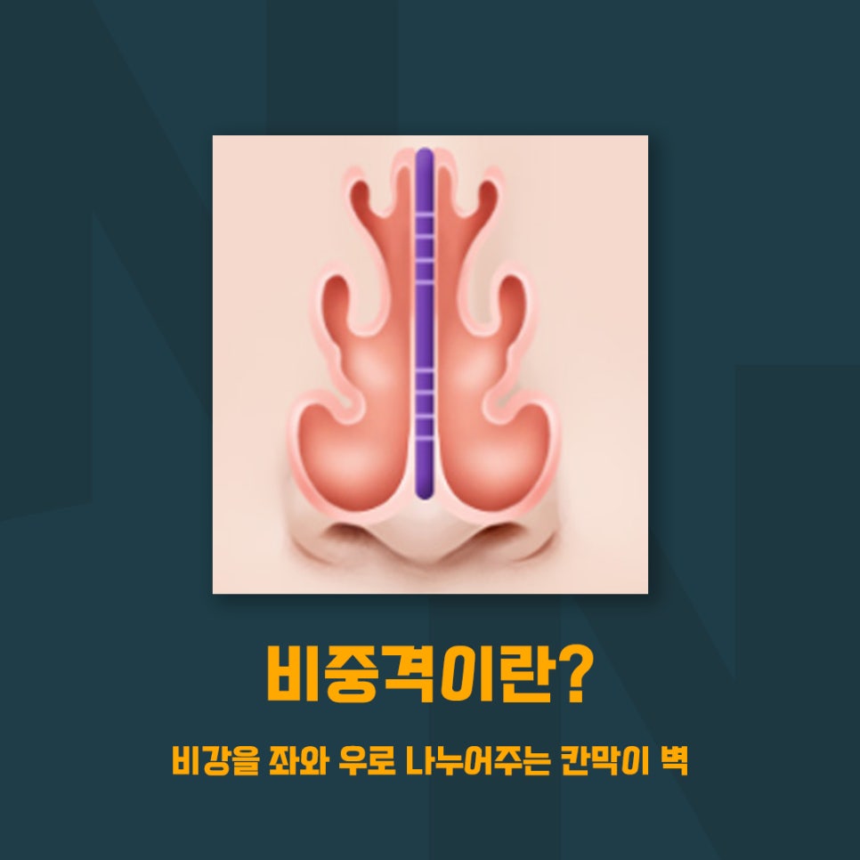 코성형,첫 수술부터 갈비뼈(자가늑연골)로 이식해야 하는 이유 관련 이미지 3
