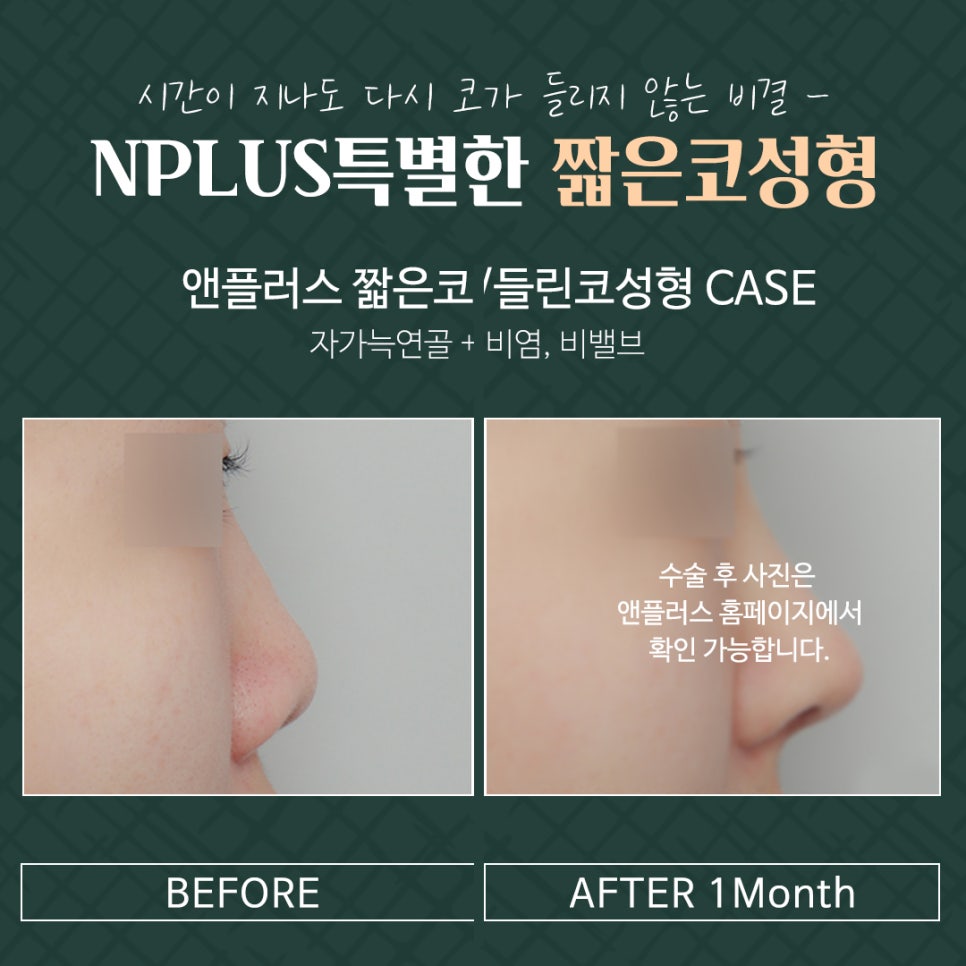 들린코수술로 이미지 개선 관련 이미지 7