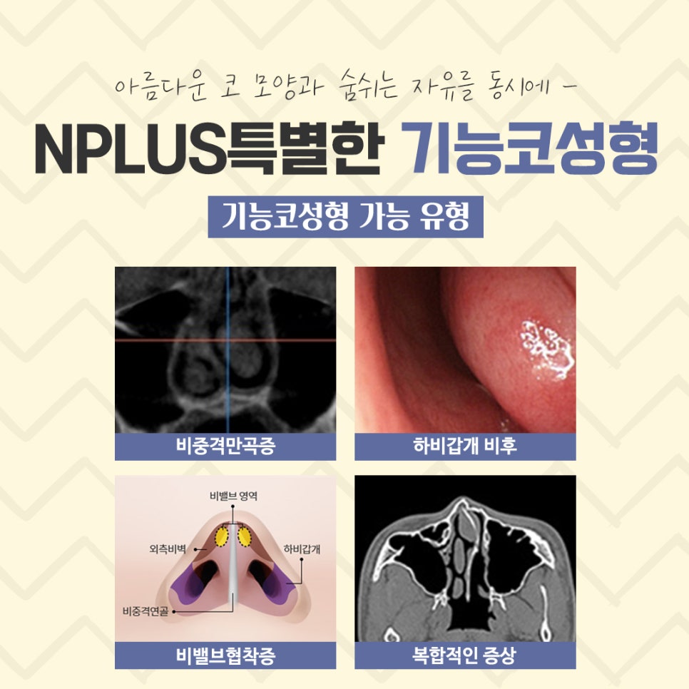 Functional Rhinoplasty Review at a Top Gangnam Nose Surgery Clinic image 6