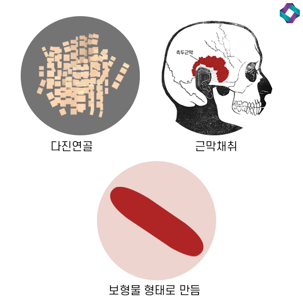 What to Know When Having Surgery Without an Implant Using Nasal Cartilage image 6
