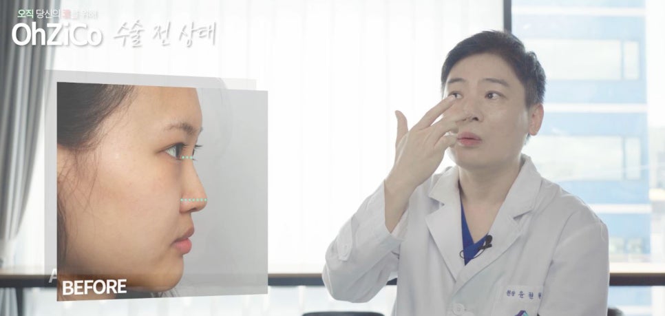 짧은코수술 후기까지 자세하게 알아보고 관련 이미지 11