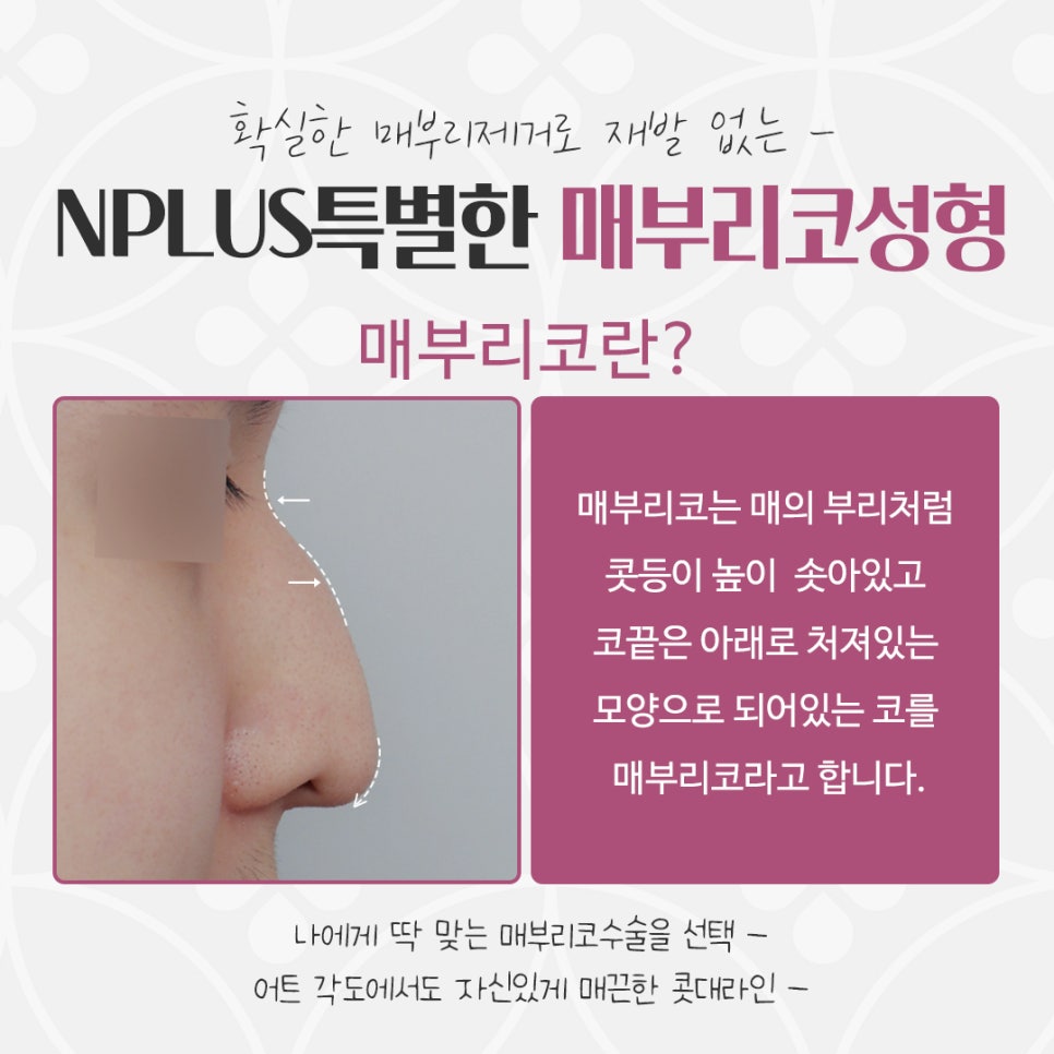 매부리코수술후기 예쁜코라인으로 관련 이미지 4