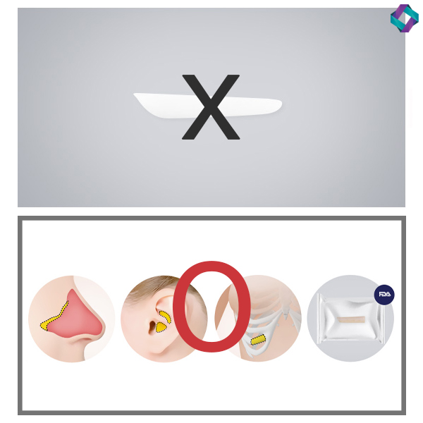 What to Know When Having Surgery Without an Implant Using Nasal Cartilage image 2