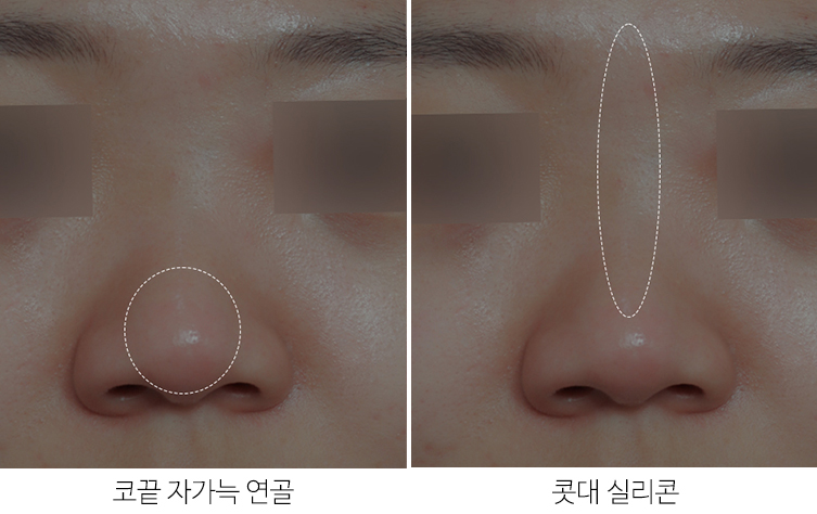 낮은코성형 비염수술도 예쁘게 관련 이미지 3