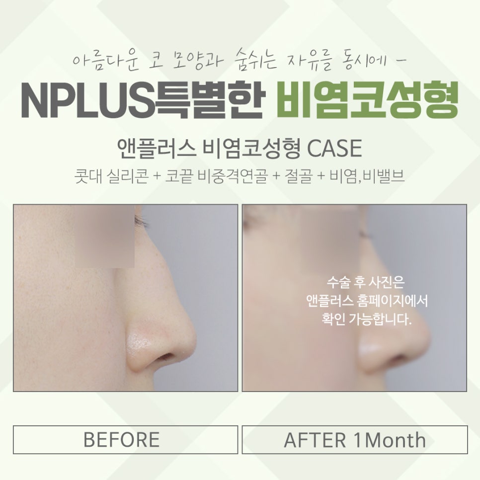 비염코수술후기에 대해 확인하여 관련 이미지 13