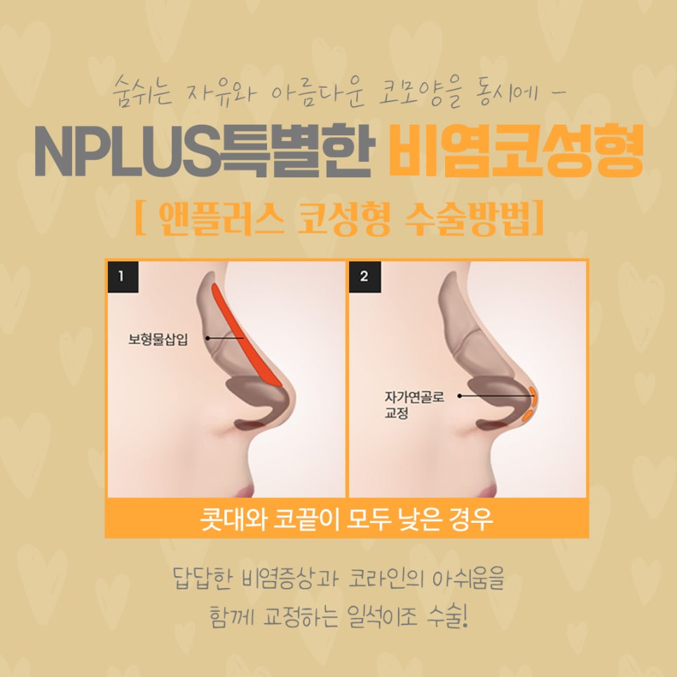 코막힘원인 정확하게 파악하는 것이 중요 관련 이미지 9