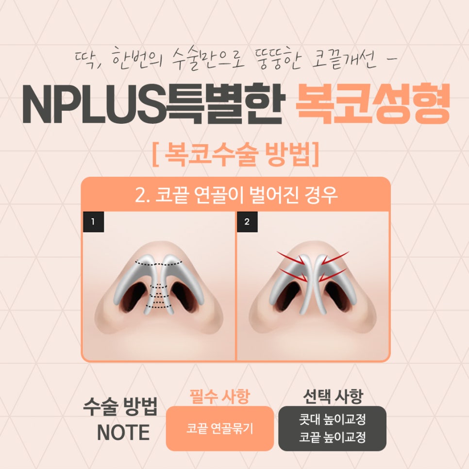 A Clear Bulbous Nose Surgery Review with Nasal Fat Removal image 7