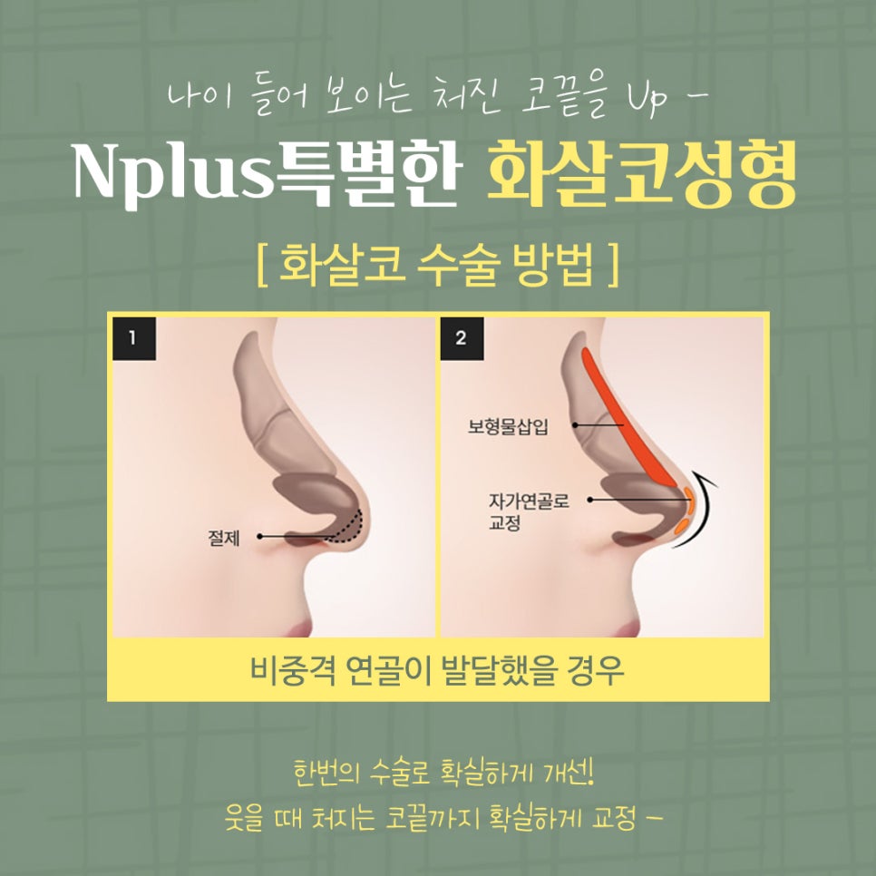 화살코성형 후기까지 확실하게 관련 이미지 9