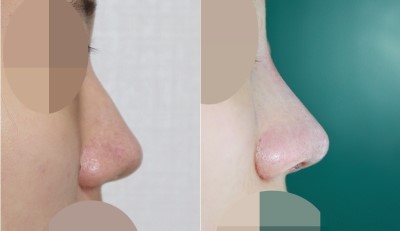 낮은코, 매부리코, 휜코수술 전후 관련 이미지 1