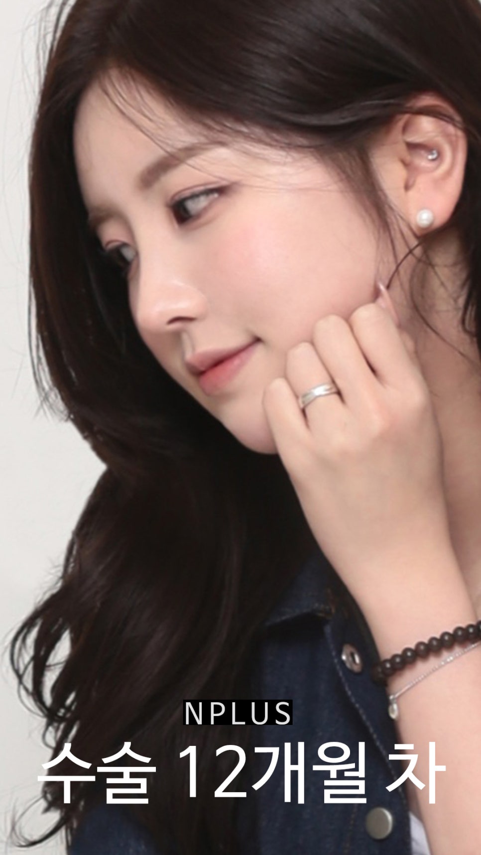 Short and Upturned Nose Shape Corrected with Autologous Rib Cartilage Nose Surgery at N Plus Clinic! image 15