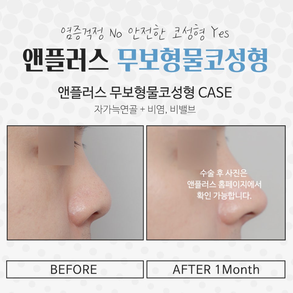 Non-Implant Rhinoplasty: Natural and Safe image 14