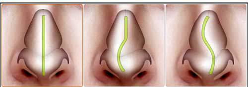 Be sure to research rhinoplasty for rhinitis before surgery! image 4