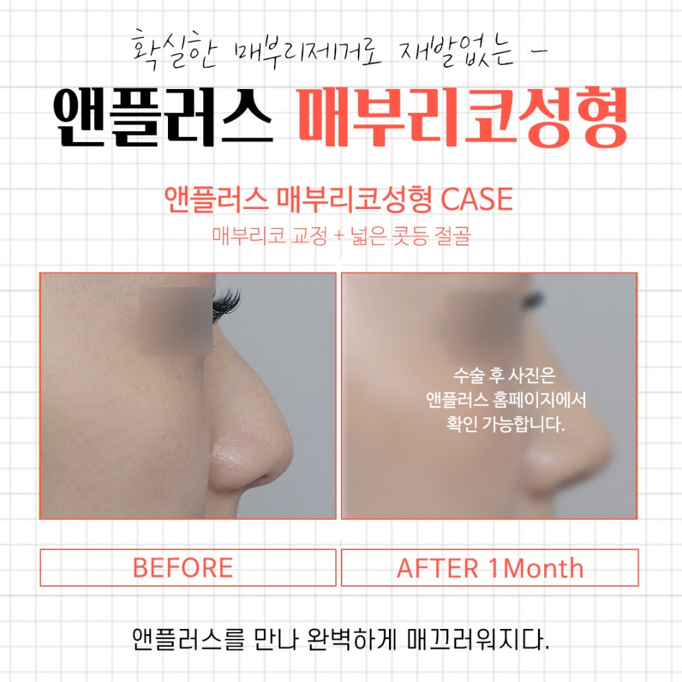 A Complete Guide to the Causes of a Hump Nose and Surgical Methods image 12