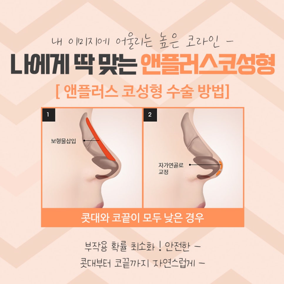 코성형 후기로 알아보고 결정 관련 이미지 9
