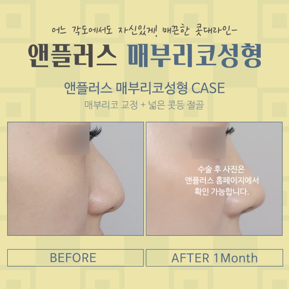 Nose Surgery Review for Correcting a Hump Nose image 12