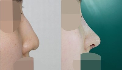 무보형물코성형 (매부리절골+코끝+비주내리기) 관련 이미지 1