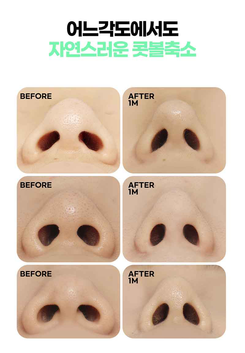 Looking into Nose Flare Reduction Reviews image 10