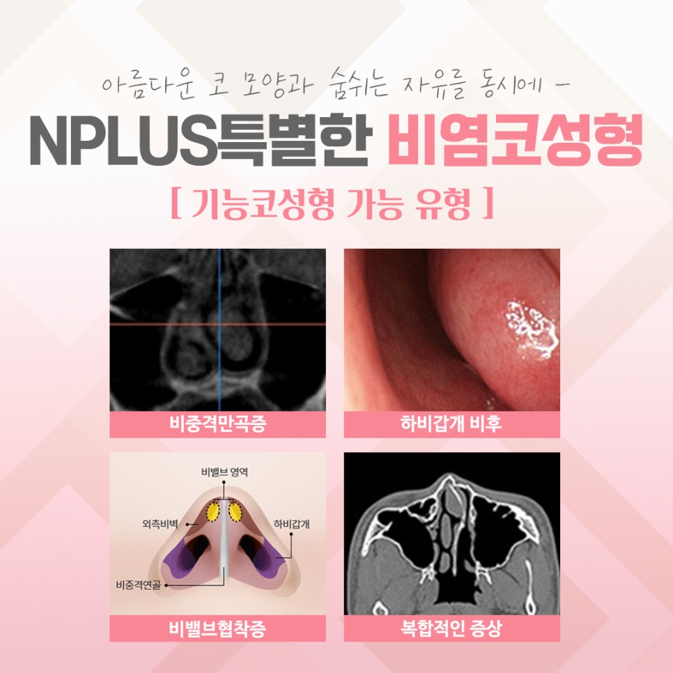 비염수술후기에 대한 정보를 알아보고 관련 이미지 4