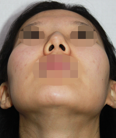 1_여자 매부리코 수술전후 관련 이미지 4
