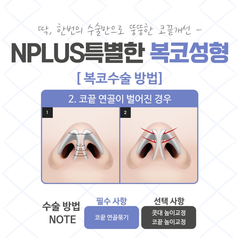 Post-Operative Review of Bulbous Nose Surgery, Improved Naturally image 8