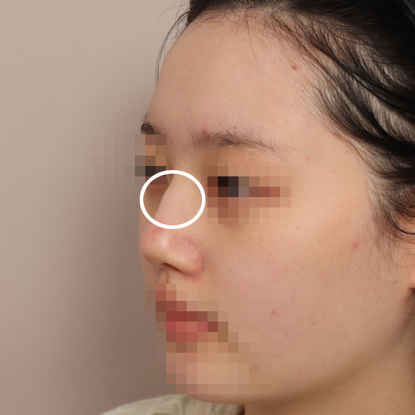 Check Whether a Non-Implant Rhinoplasty Is Possible in Your Case! image 6
