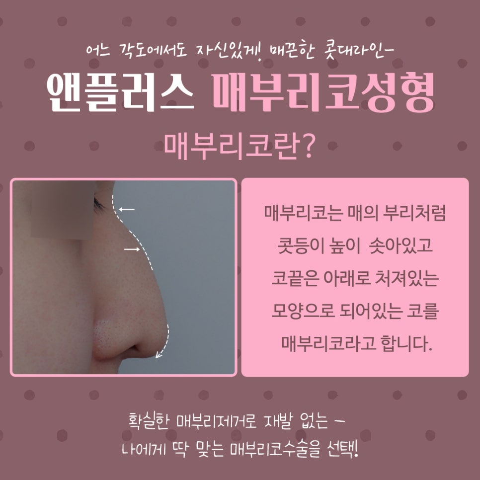 코끝처짐 개선한 매부리코성형후기 관련 이미지 4