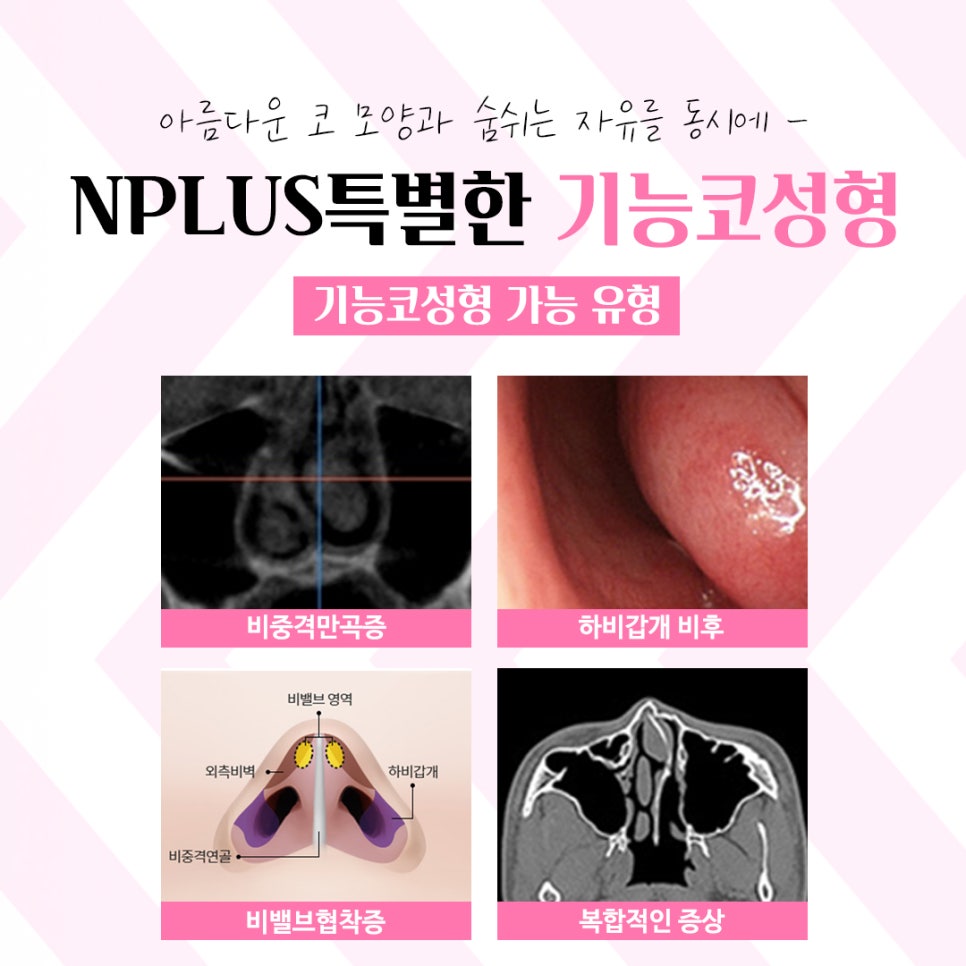 앤플러스 기능코수술후기 선택의 중요성 관련 이미지 5