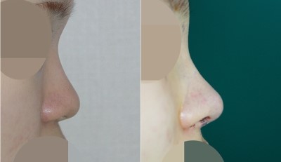 작은코 성형, 낮은코 수술전/수술직후 사진 관련 이미지 1