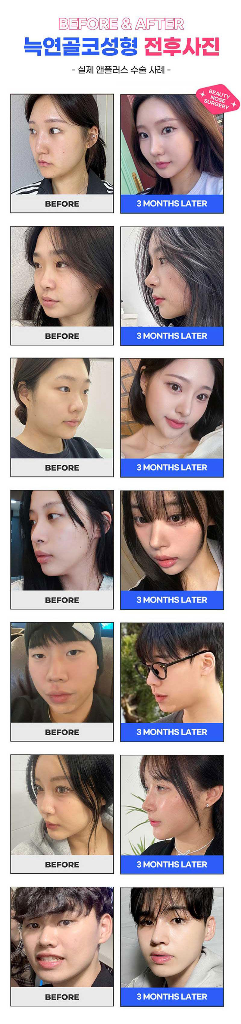 자가늑연골코성형비용에 대해 알아본다면?! 관련 이미지 4