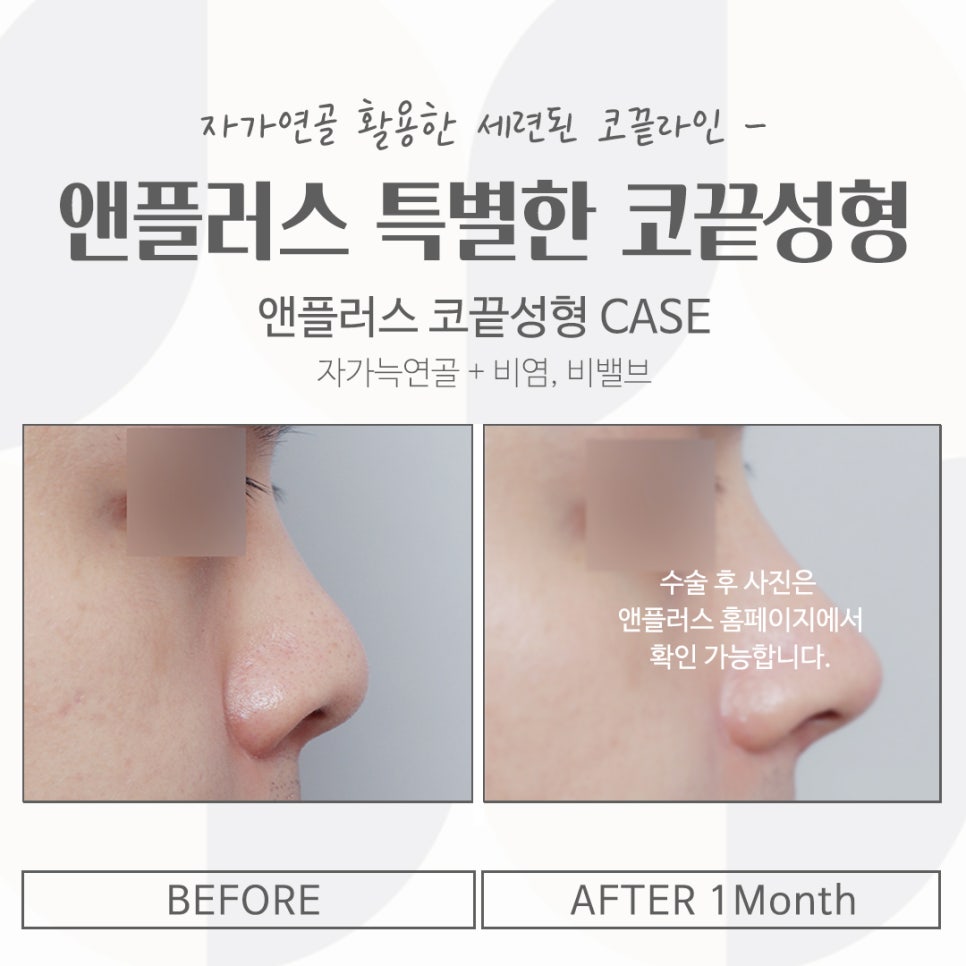 코끝연골묶기로 자연스러운 코라인 관련 이미지 16