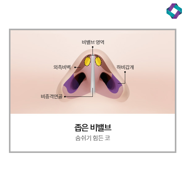 비염수술코성형 비밸브 교정술! 관련 이미지 2