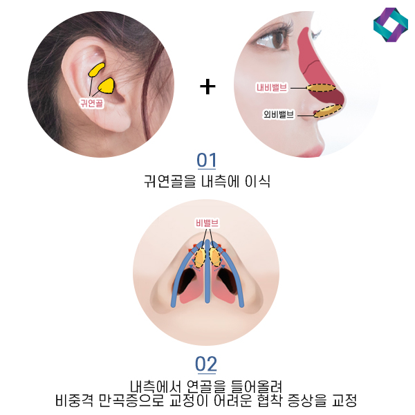 비염수술코성형 비밸브 교정술! 관련 이미지 10