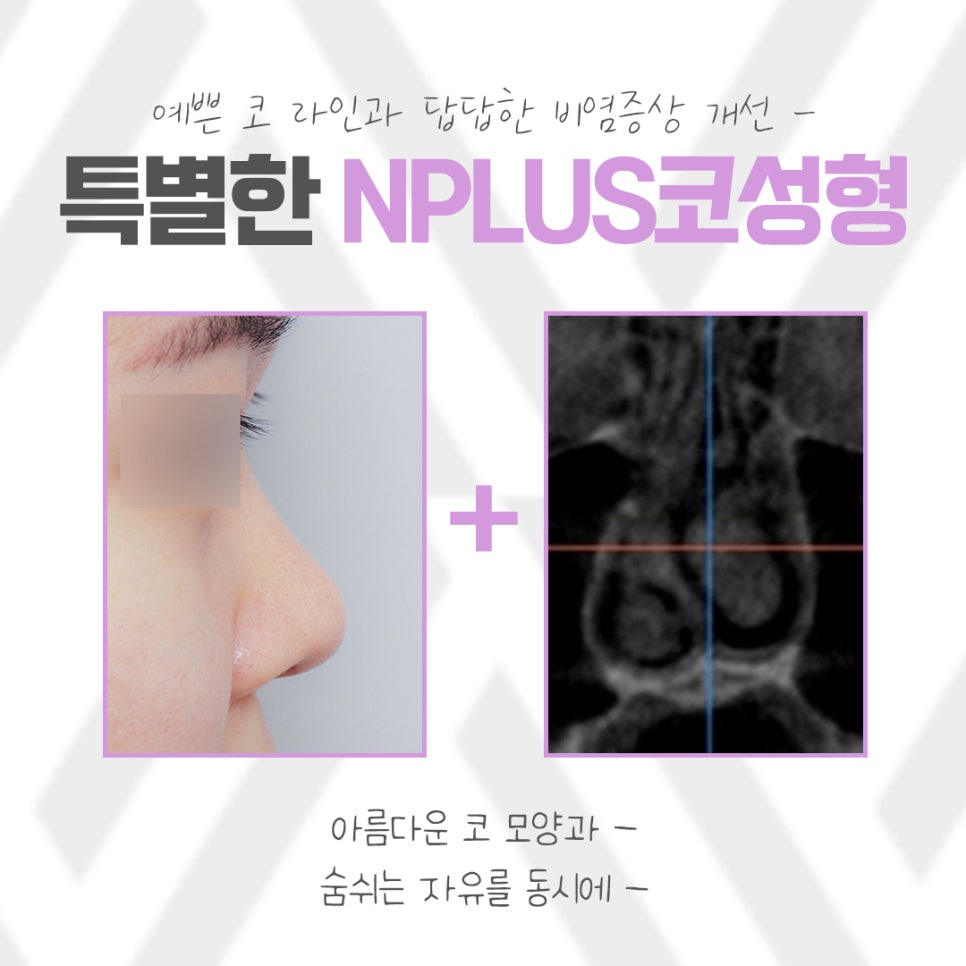 낮은코성형에 대한 정보를 찾아본다면 관련 이미지 3