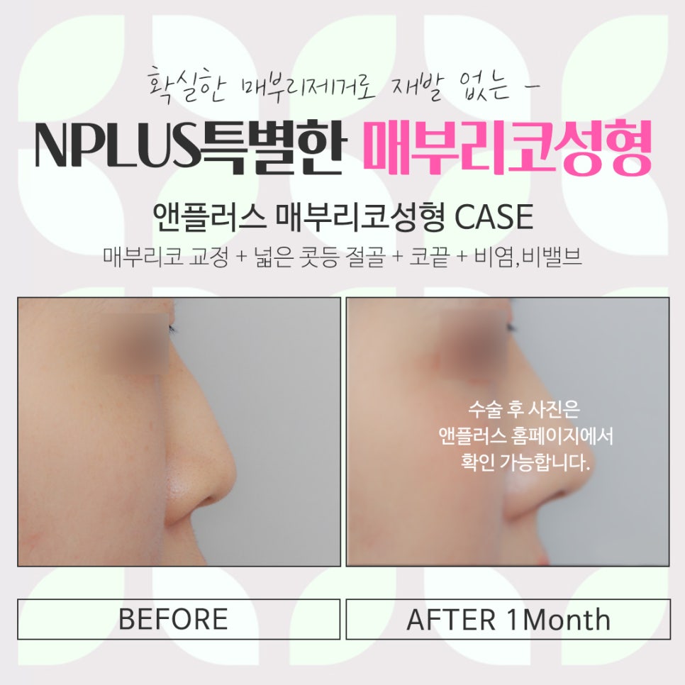 A Refined Look Through Female Hump Nose Surgery image 17
