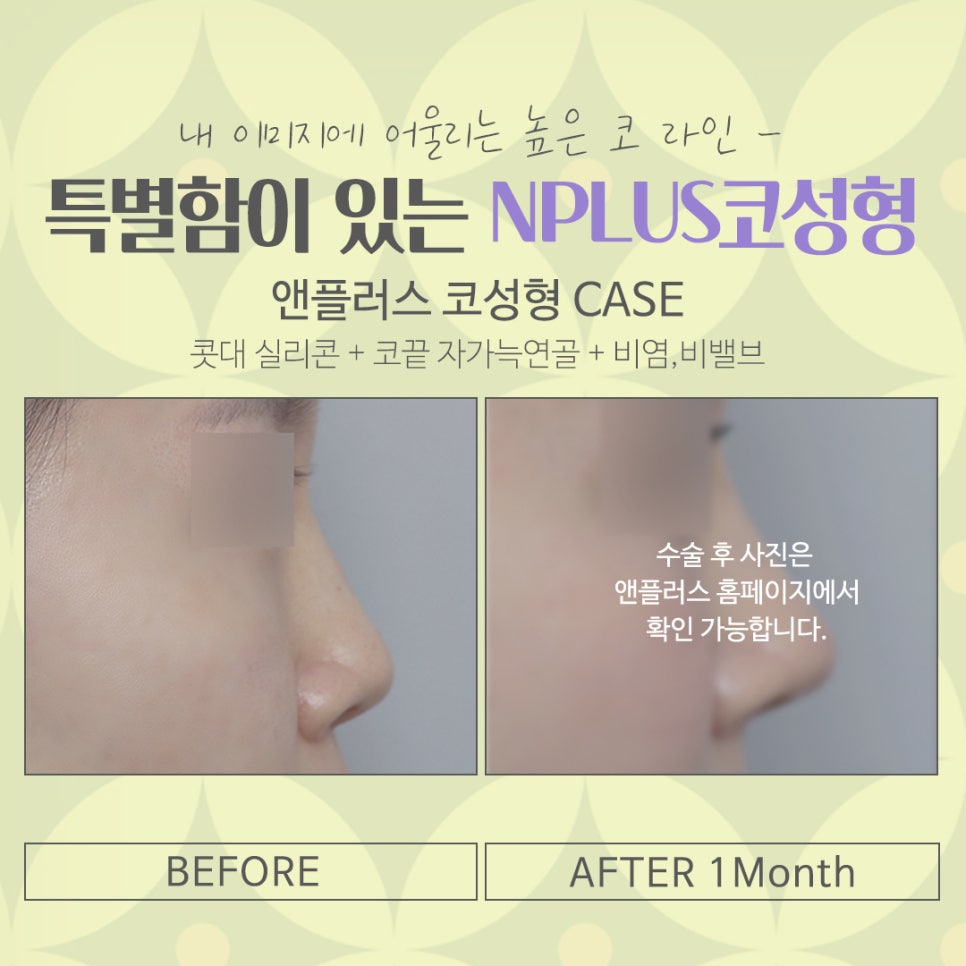 압구정코수술에 대해 찾아보고 관련 이미지 14