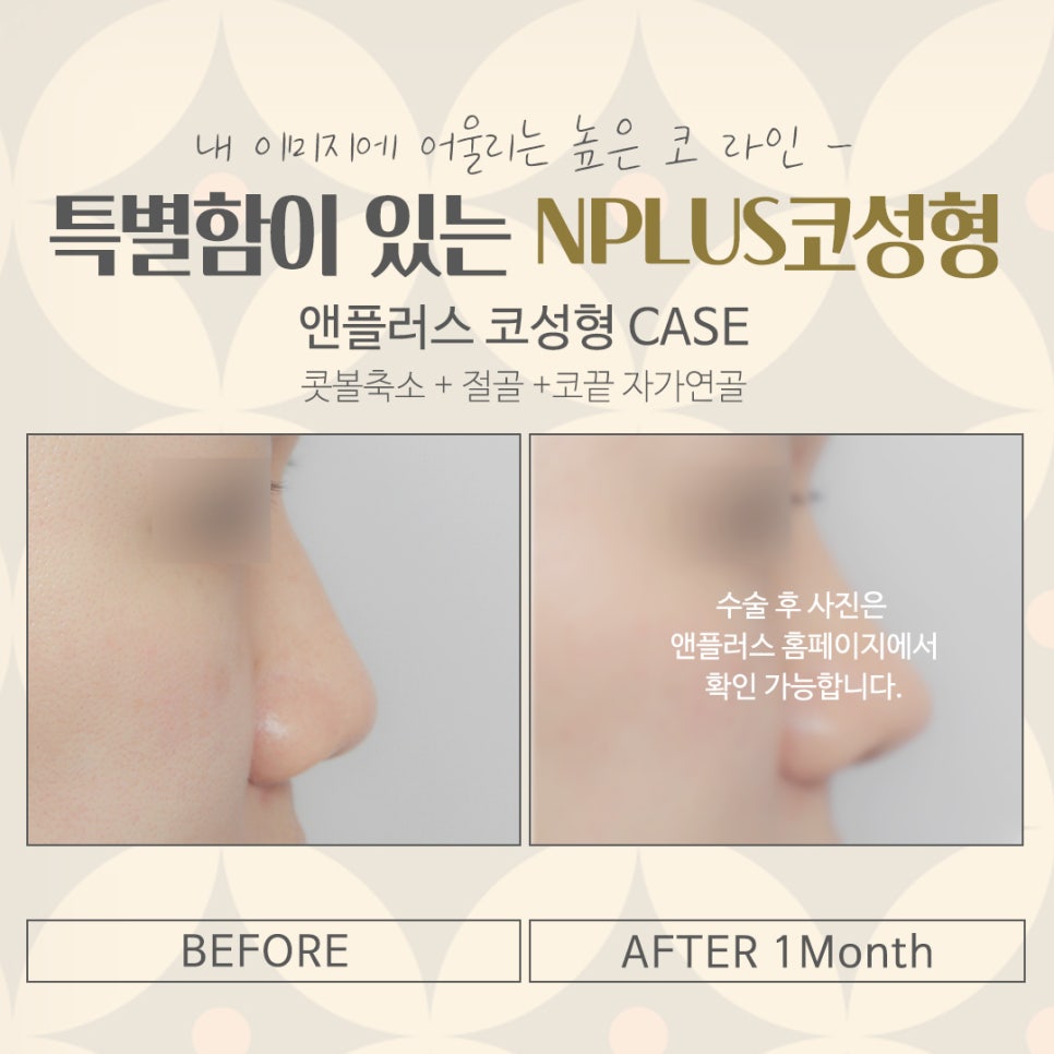 코수술병원을 꼼꼼하게 체크하여 관련 이미지 15