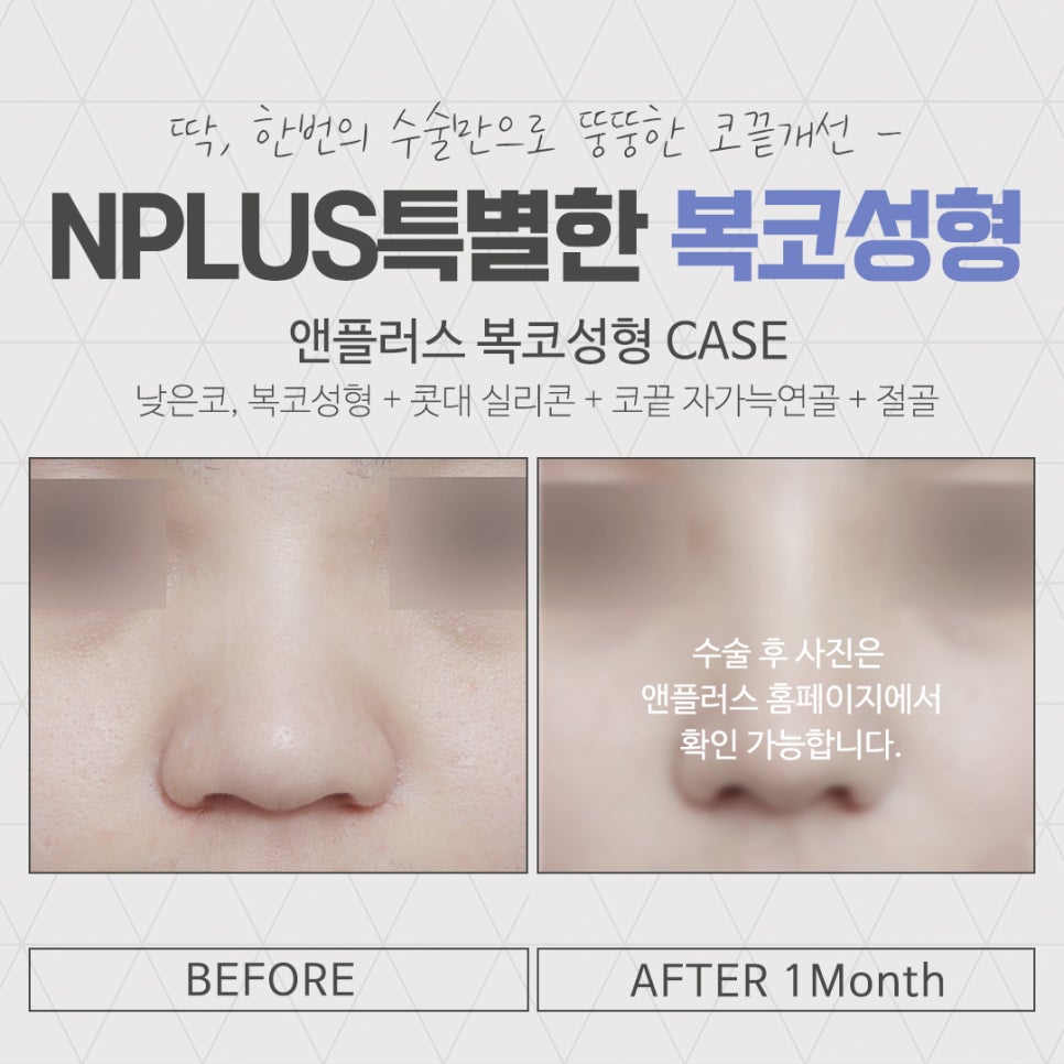 복코성형후기로 알아보는 코지방제거 관련 이미지 15
