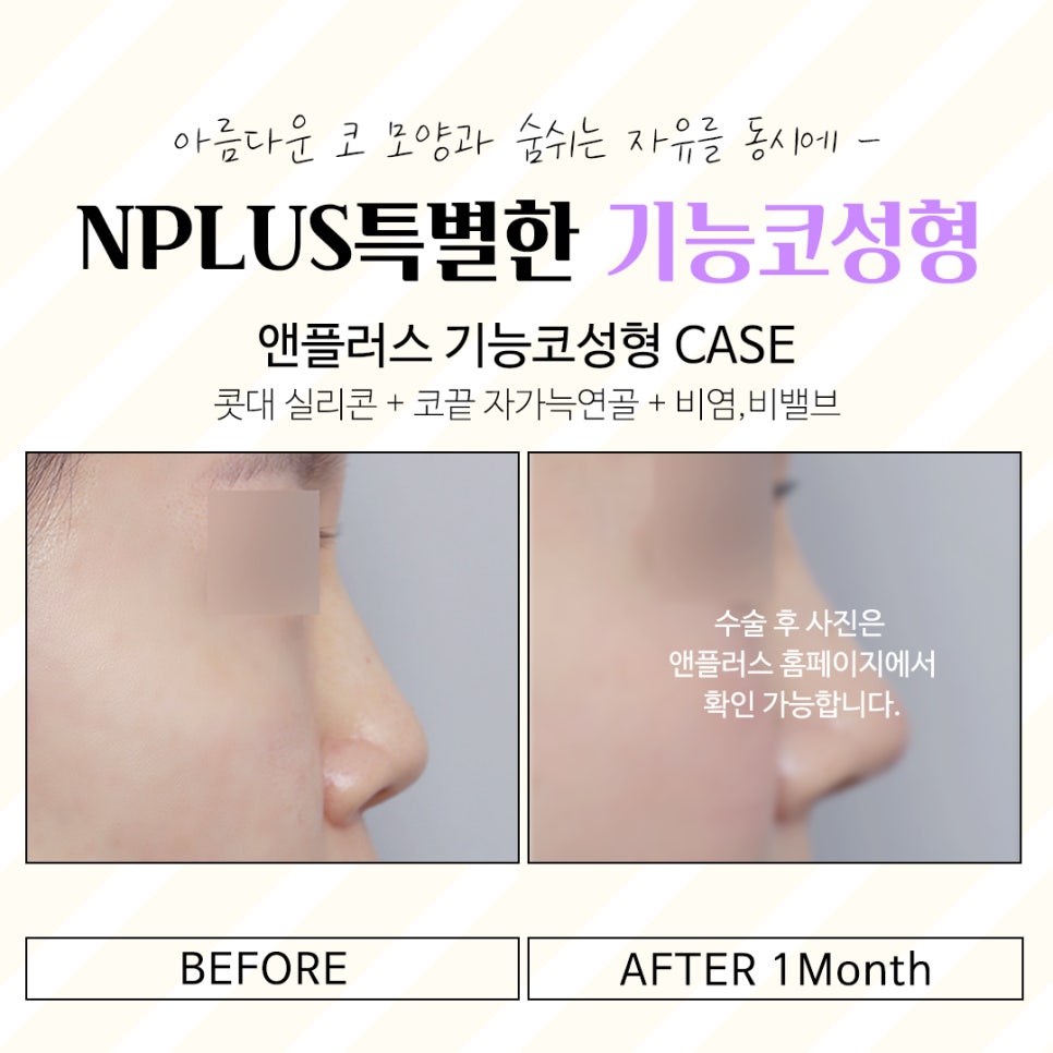 Accurately Reviewing Rhinoplasty Experience image 3