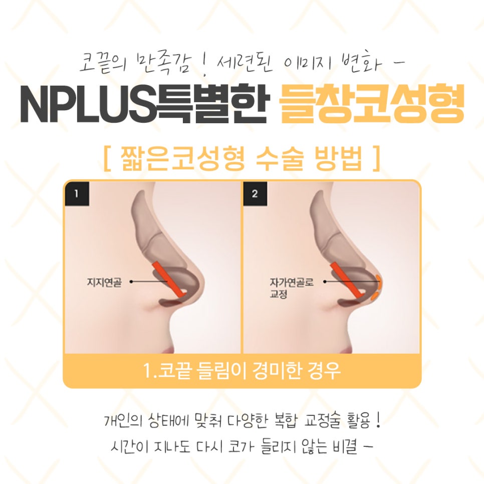 들창코수술에 대해 자세하게 알아보고 관련 이미지 8