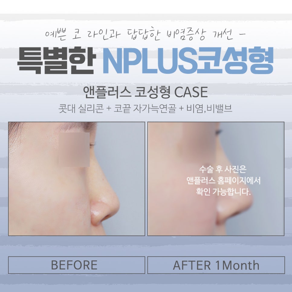 낮은코성형에 대해 꼼꼼하게 체크하고 관련 이미지 12