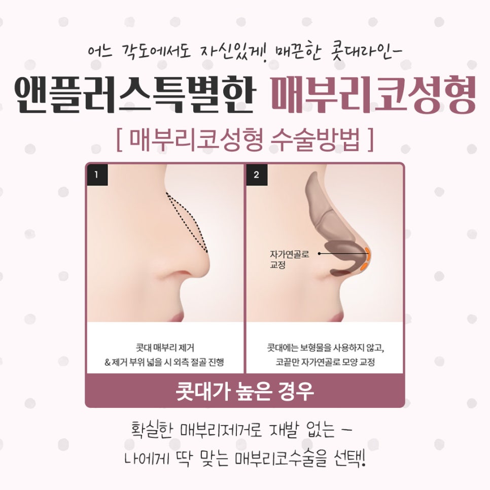 매부리코성형후기 꼼꼼하게 알아보고 관련 이미지 10