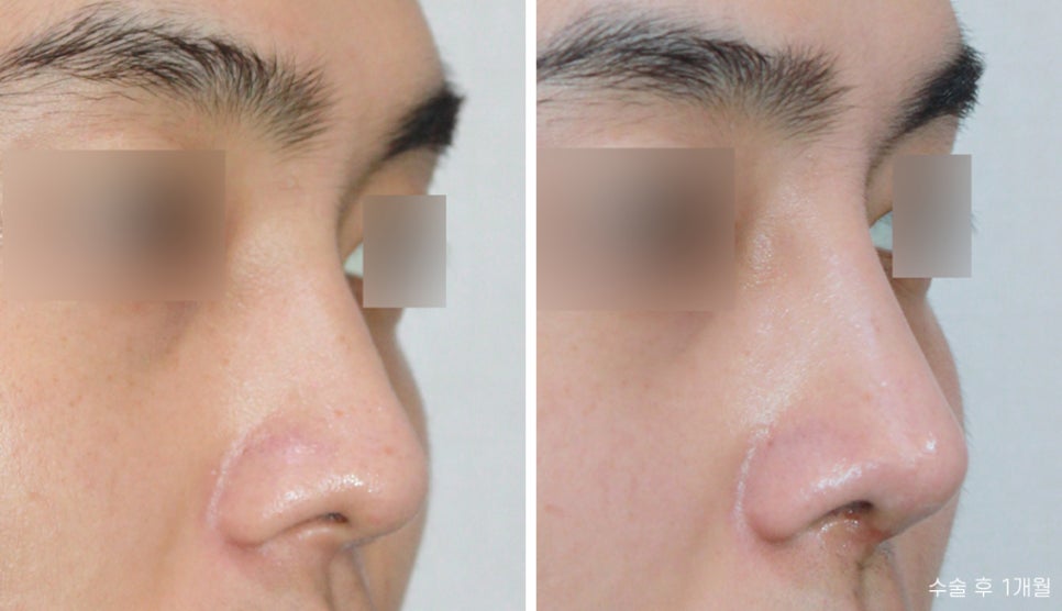 Male Nose Surgery Before and After: Tip Correction image 1