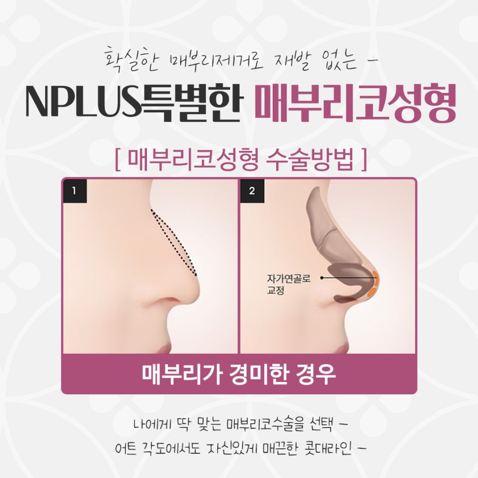 매부리코수술후기 예쁜코라인으로 관련 이미지 12