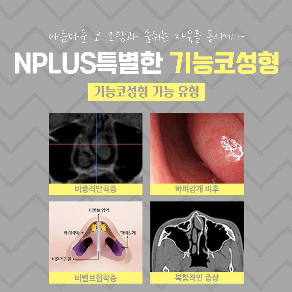 기능코성형을 통한 한쪽 코막힘 개선 관련 이미지 4
