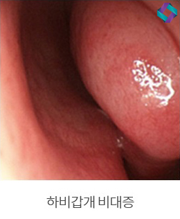 기능코성형 비중격만곡증(비중격교정술)과 코막힘원인 관련 이미지 6