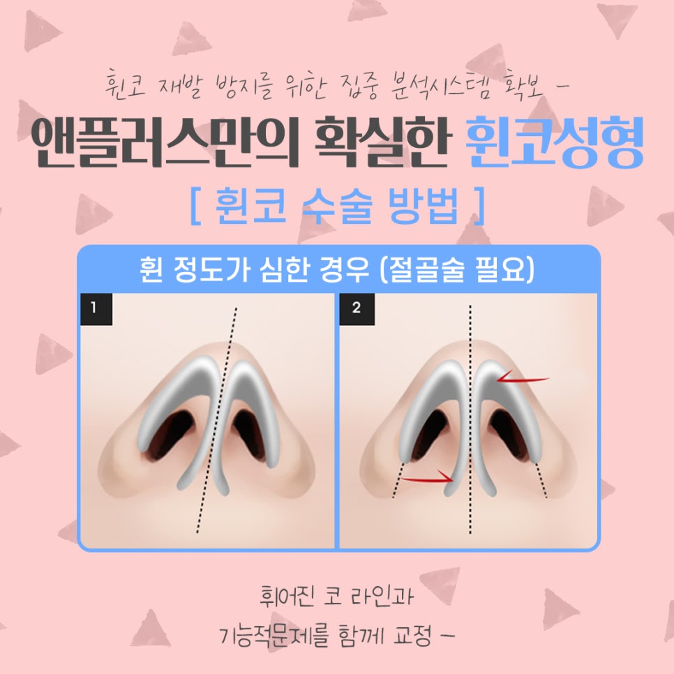 휜코수술후기 꼼꼼하게 알아보고 관련 이미지 9