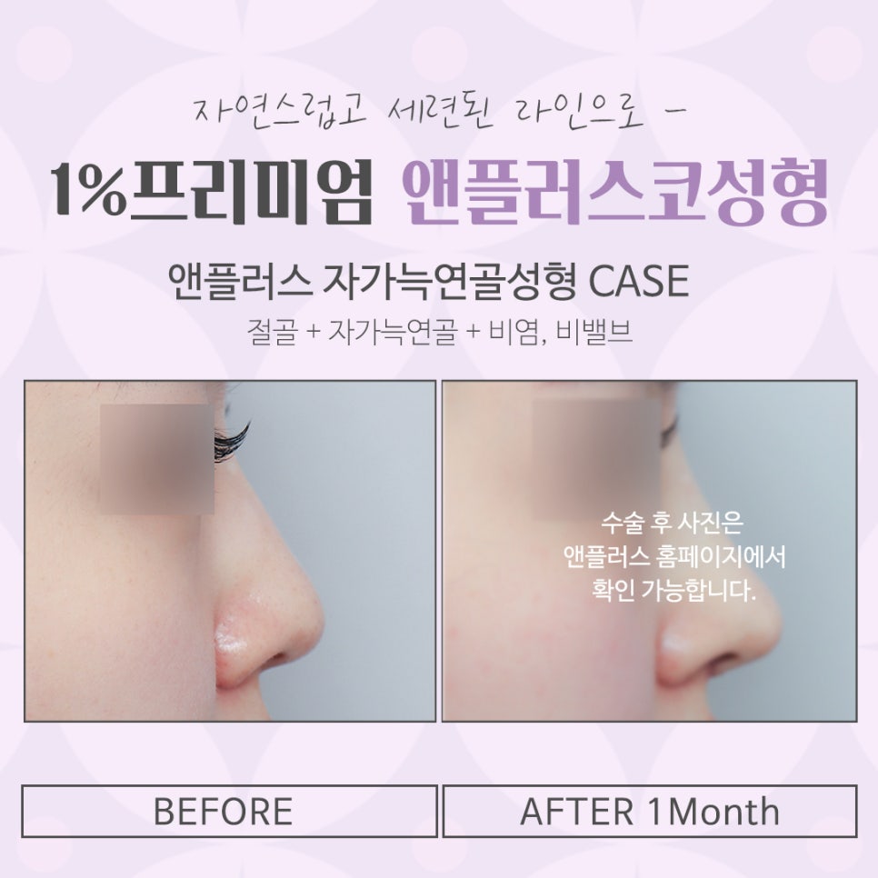 늑연골 코수술 자세하게 알아보고 관련 이미지 16
