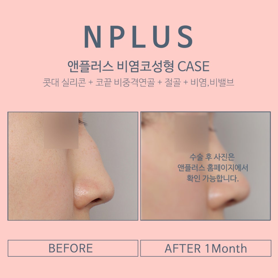 Septoplasty Surgery at N+ image 10